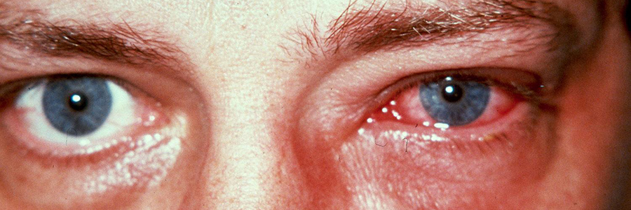 Eye Infections – Dr. Faramarz Davidi