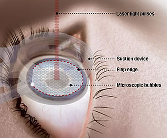 Lasik Laser Vision Correction
